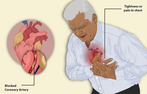1. Angina