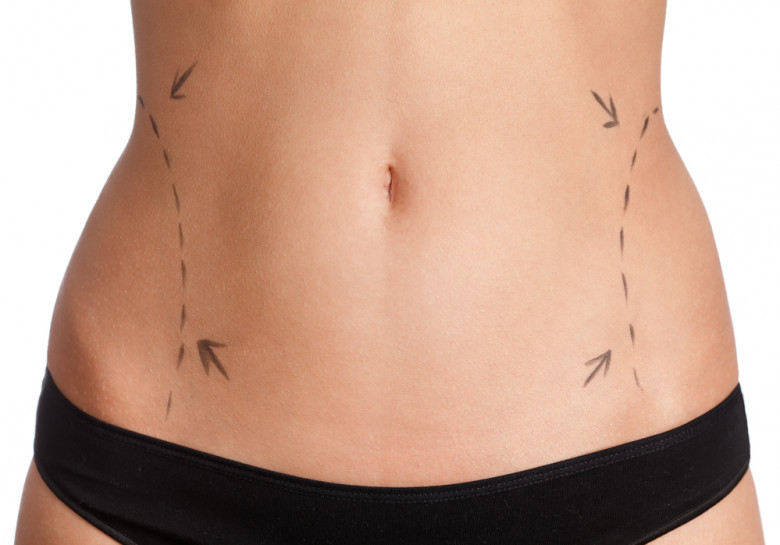 Abdominal Liposuction Manhattan NYC
